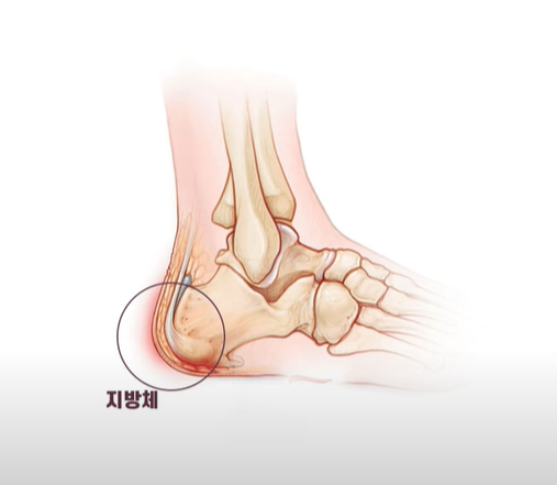 발바닥통증의 원인과 부위별 설명 병원 선택 정보