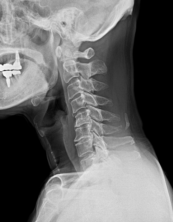 C-spine lateral