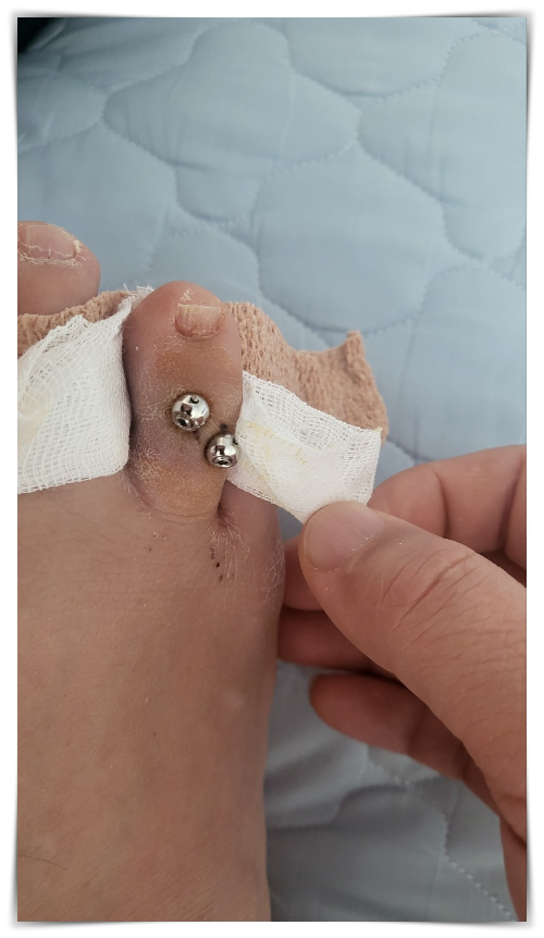 발가락-핀박힌 발가락- 붕대로 감아진 사진