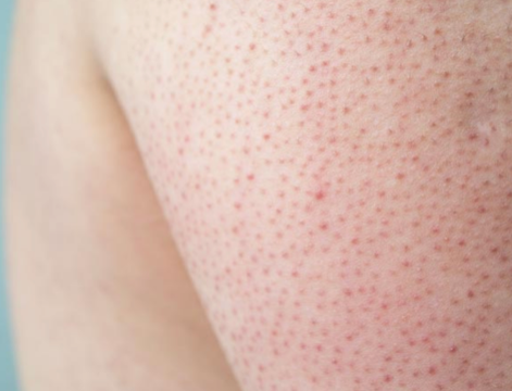 모공각화증의 원인