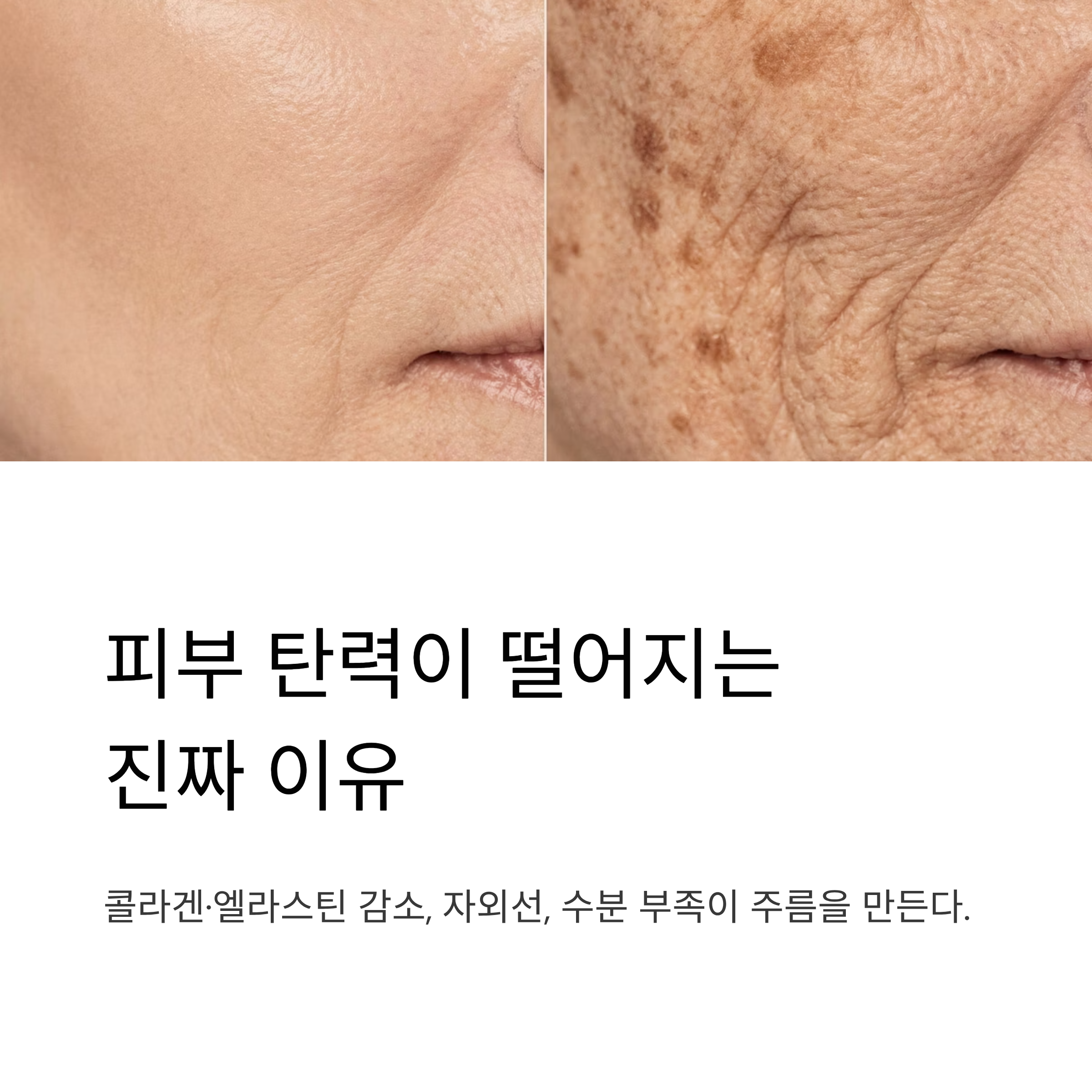 피부 탄력