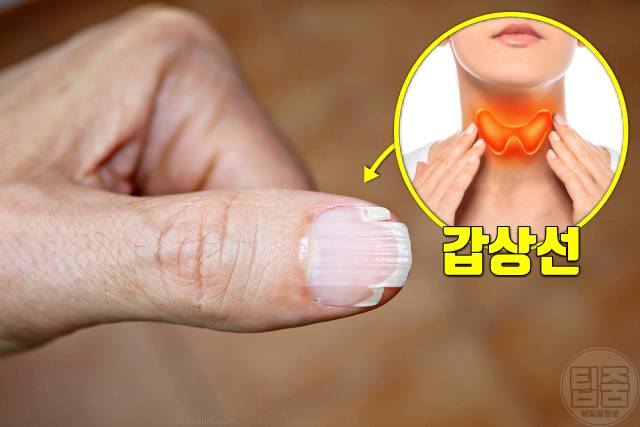 손톱 색깔 건강 손톱 갈라짐 부러짐 갑상선