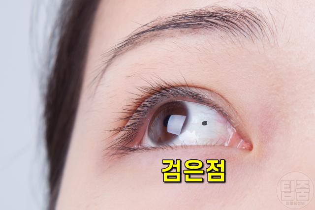 눈 흰자 검은점, 결막모반, 흑색종,팁줌