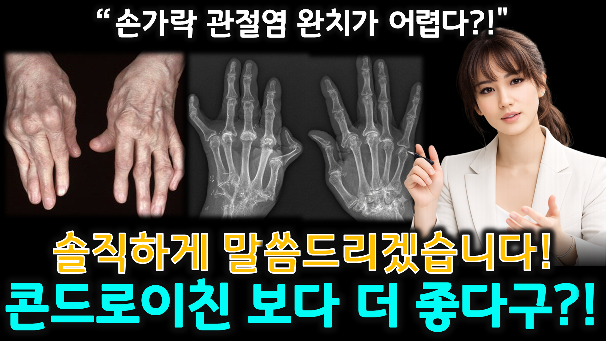 손가락 관절염 (콘드로이친 한계, 우슬 효과, 복합 성분)