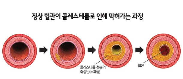 고지혈증