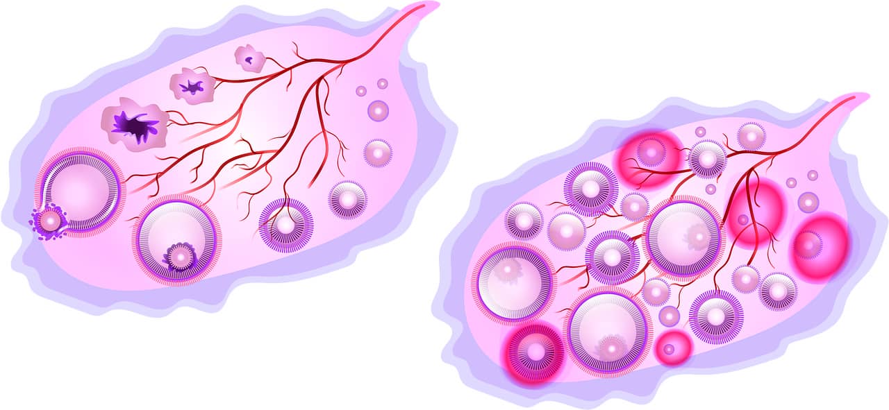 다낭성 난소 증후군(PCOS) 완벽 가이드 : 호르몬 균형과 생활 습관 관리법