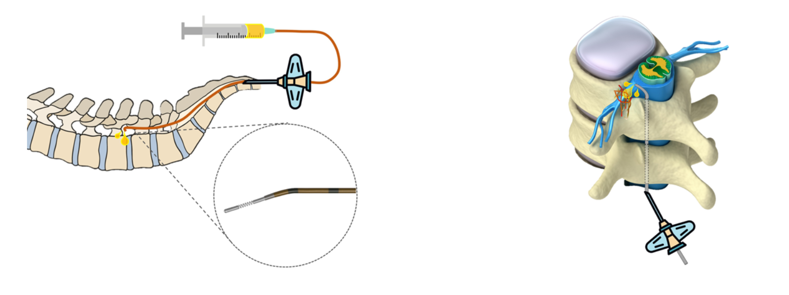 신경성형술 이미지