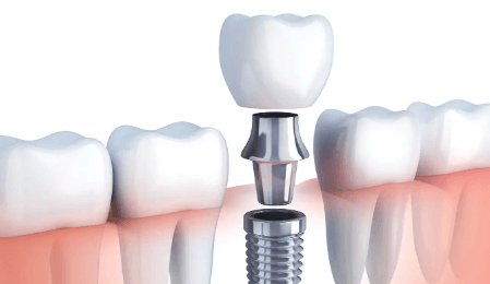 무절개 임플란트 시술 과정