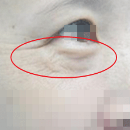 하안검수술을 하기 전 여성의 눈밑 주름 상태