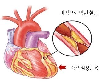 심근경색 심장사진