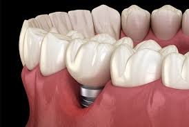 잇몸이 붓고 아플 때
