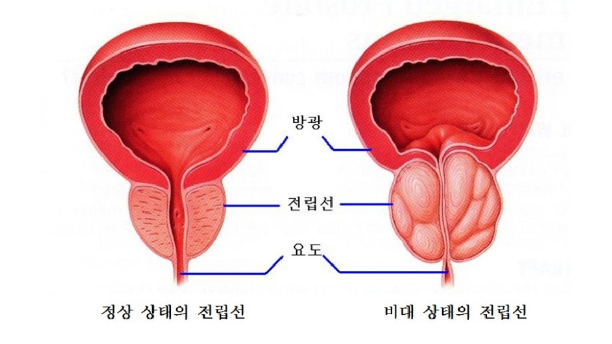 정상 전립선과 비대해진 전립선 비교 이미지, 방광&middot;요도 압박 차이를 보여줌