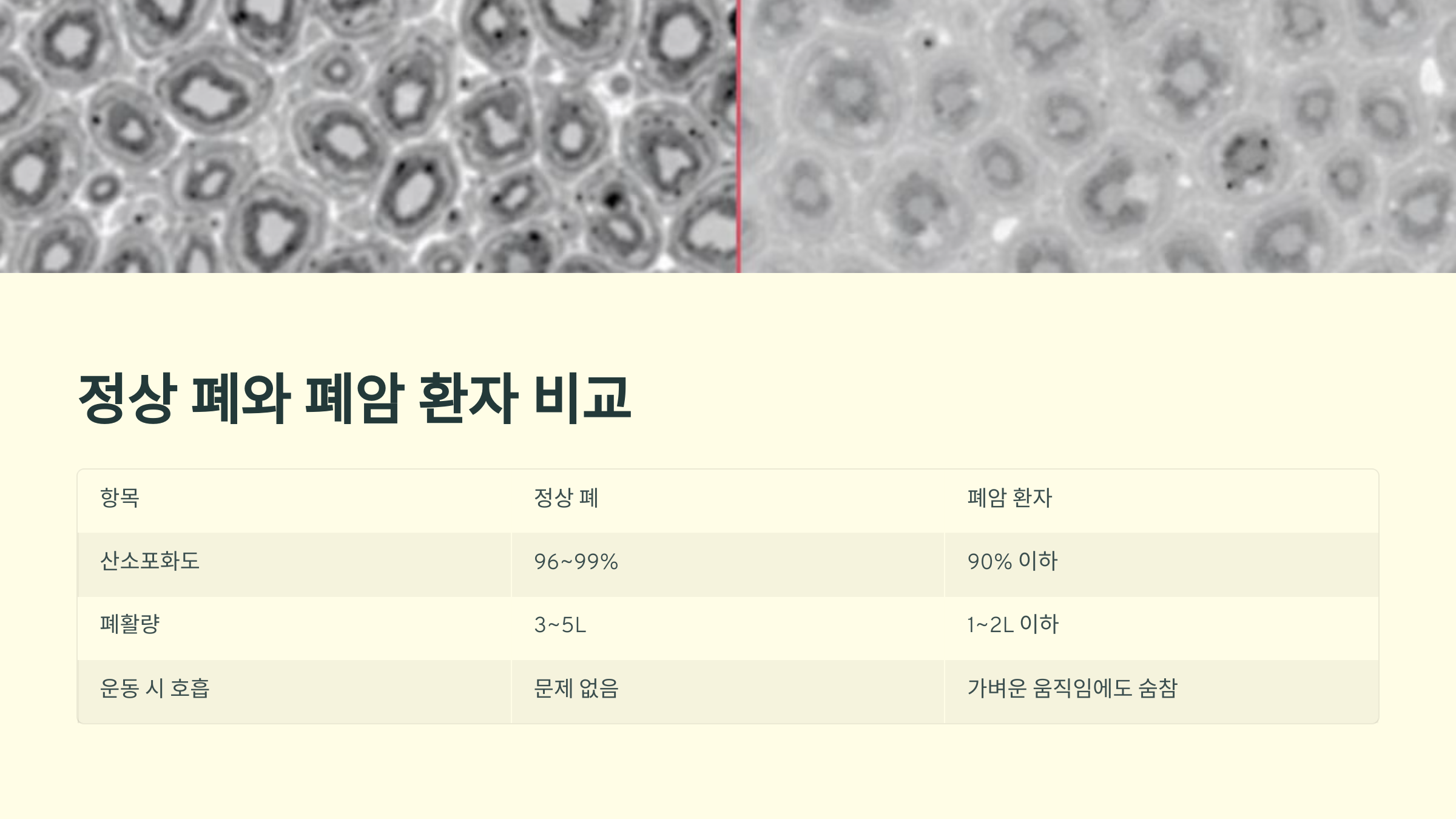 정상 폐와 폐암 환자 비교