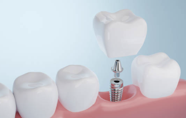 임플란트 시술과정