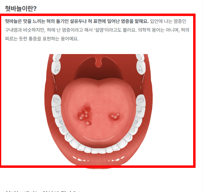 혓바늘이 돋는 이유 알아보기