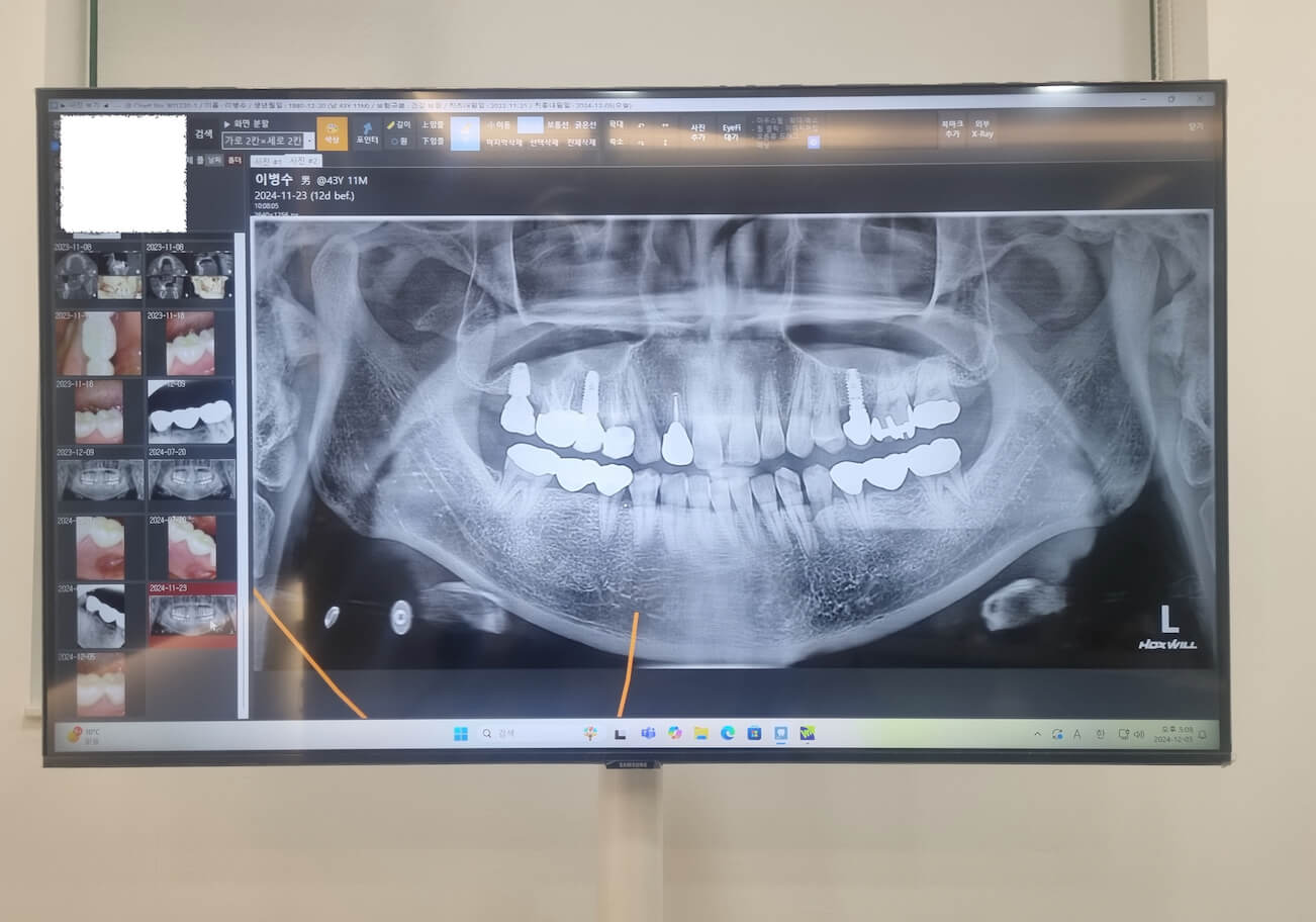 치아 브릿지 가격