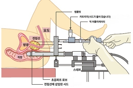 전립선암 소선원치료