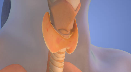 갑상선 기능 항진증 증상, 수치, 검사 총정리 (2024ver)