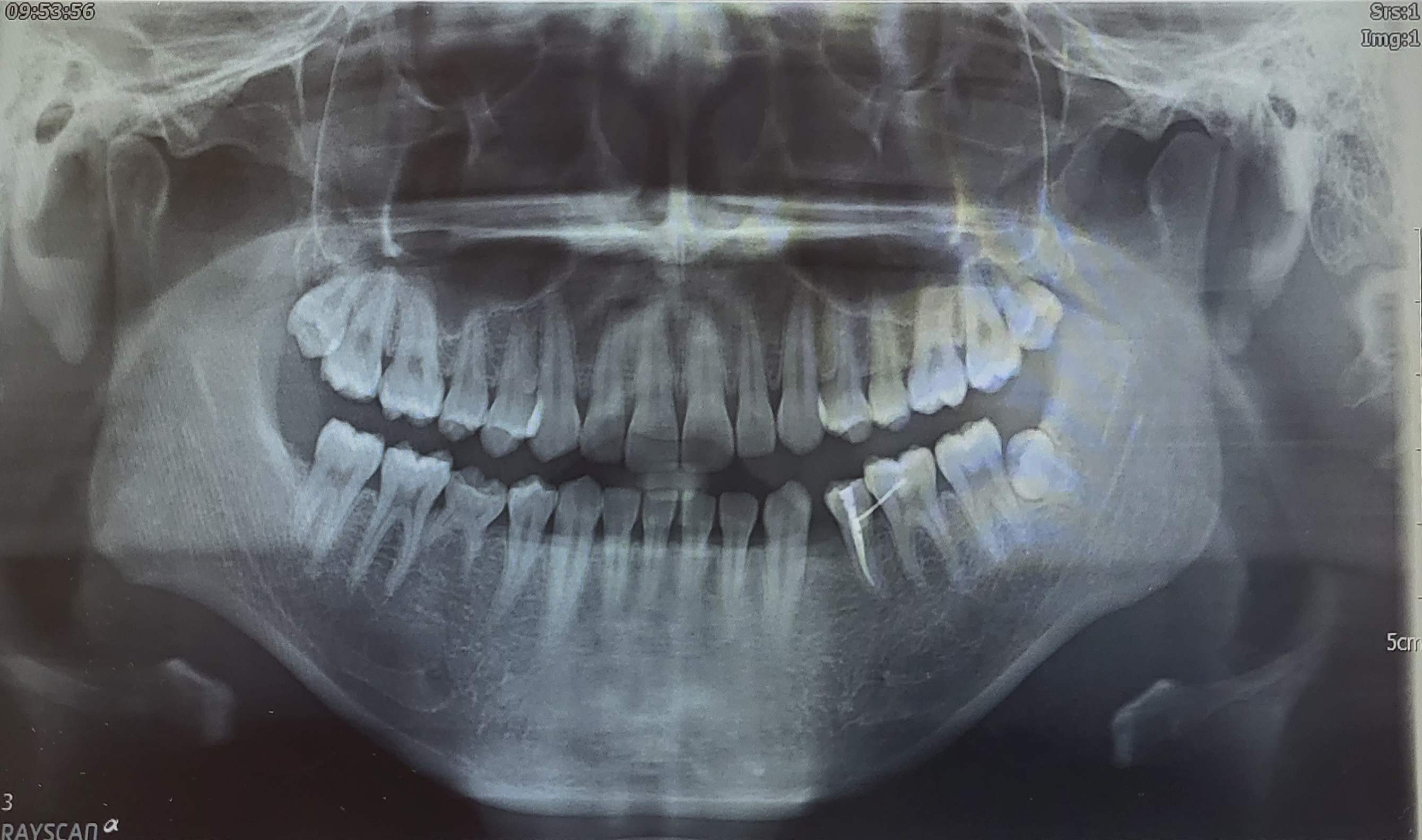 영구치 결손 치료 관련 파노라마 촬영본