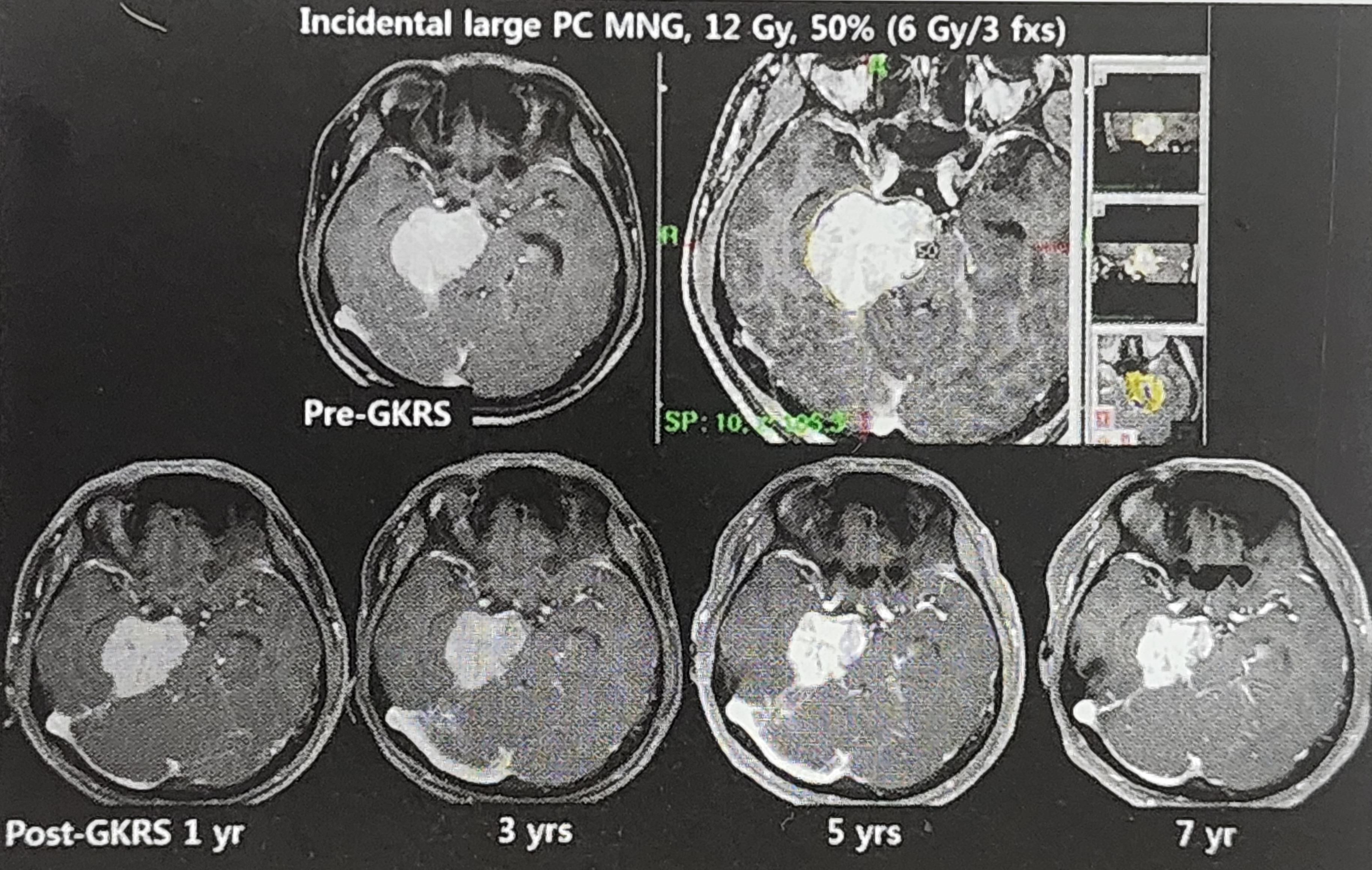 뇌수막종에 대한 방사선수술