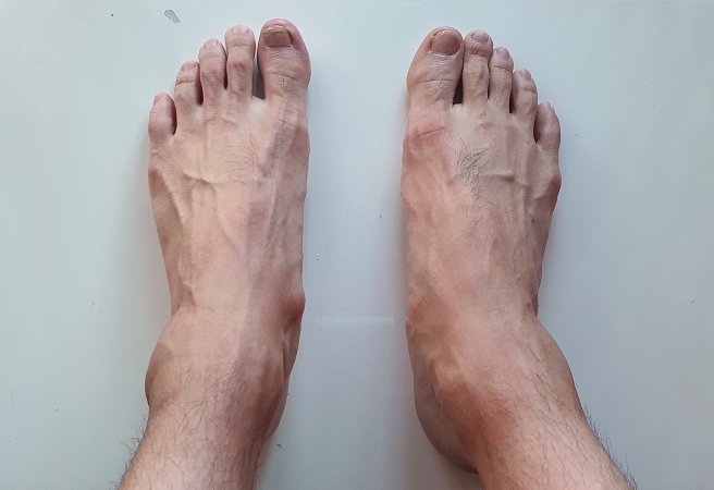 부주상골증후군_정상발과_차이