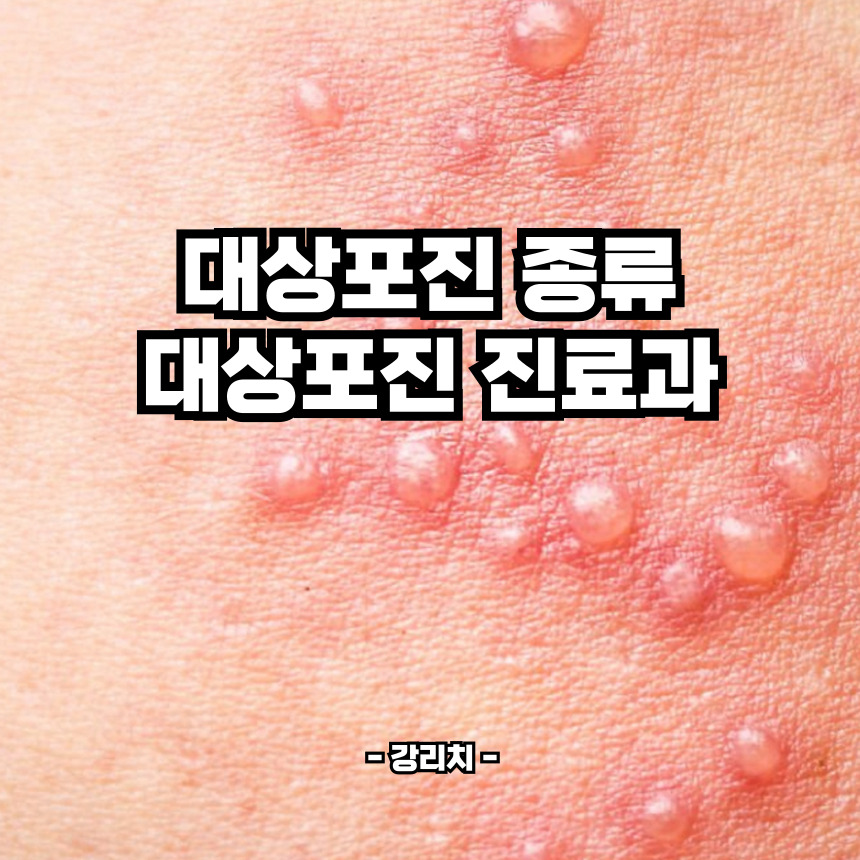 대상포진 백신 종류