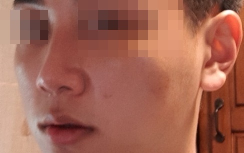 비중격 만곡증 수술 후기