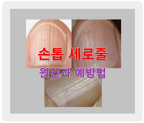 손톱 세로줄 원인부터 예방법까지, 건강 신호 읽는 법