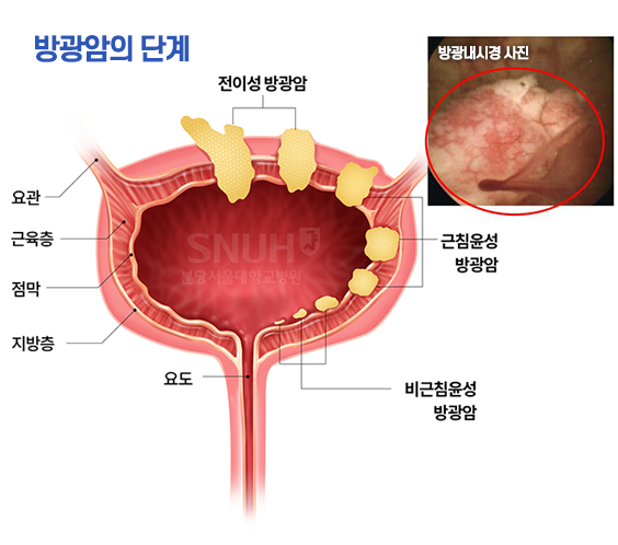 EBS 명의 다시보기 방광암 수술 혈뇨