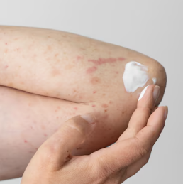 대상포진 초기증상 3