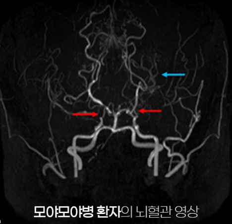 모야모야병 뇌혈관 영상