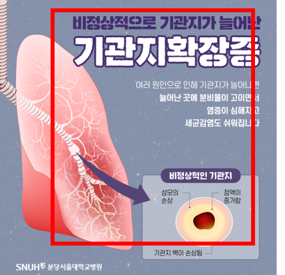 가래가 생기는 원인 알아보기