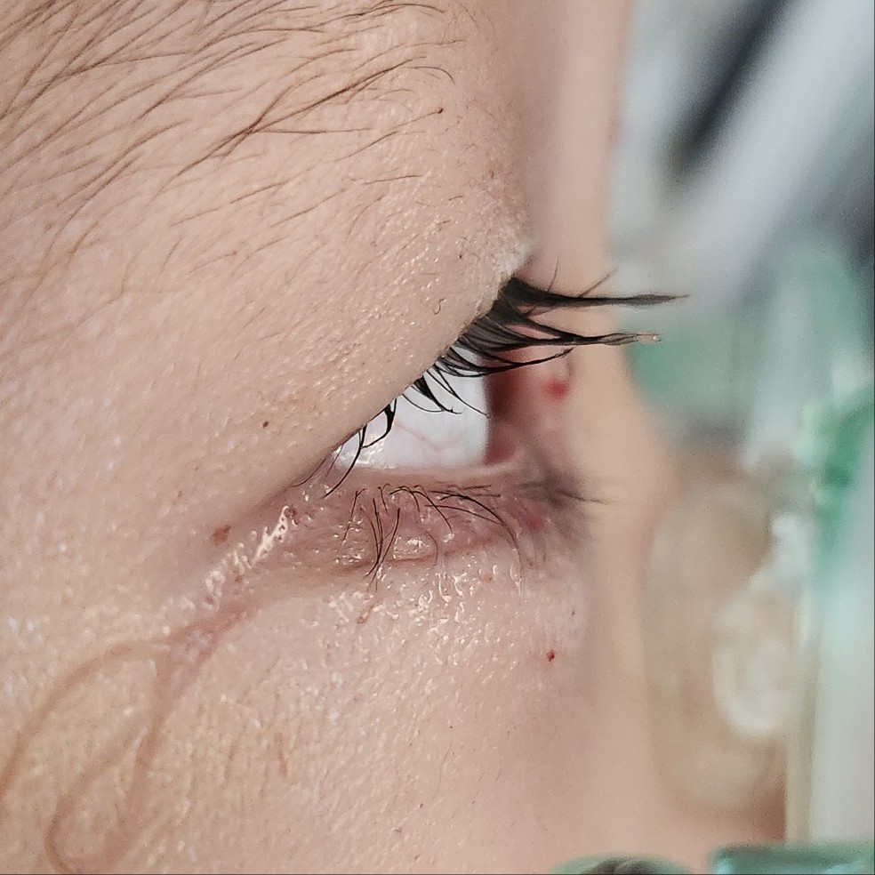 수술 1일 후 눈 옆모습