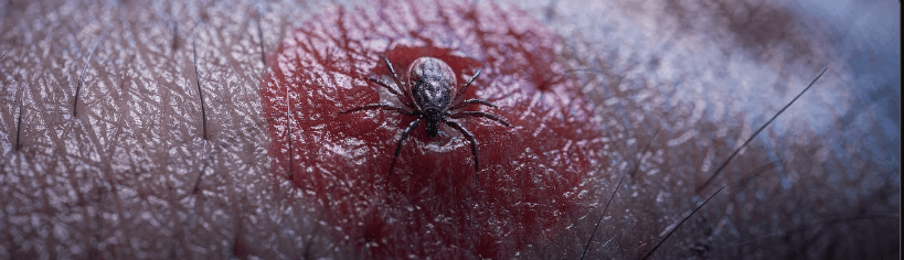 진드기 물린 후 증상과 치료방법
