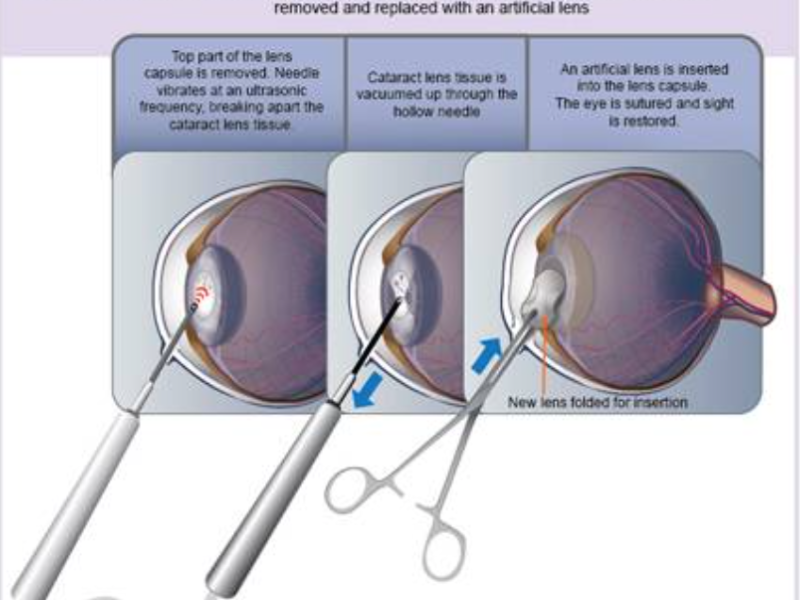 수정체 유화술 수술과정 이미지