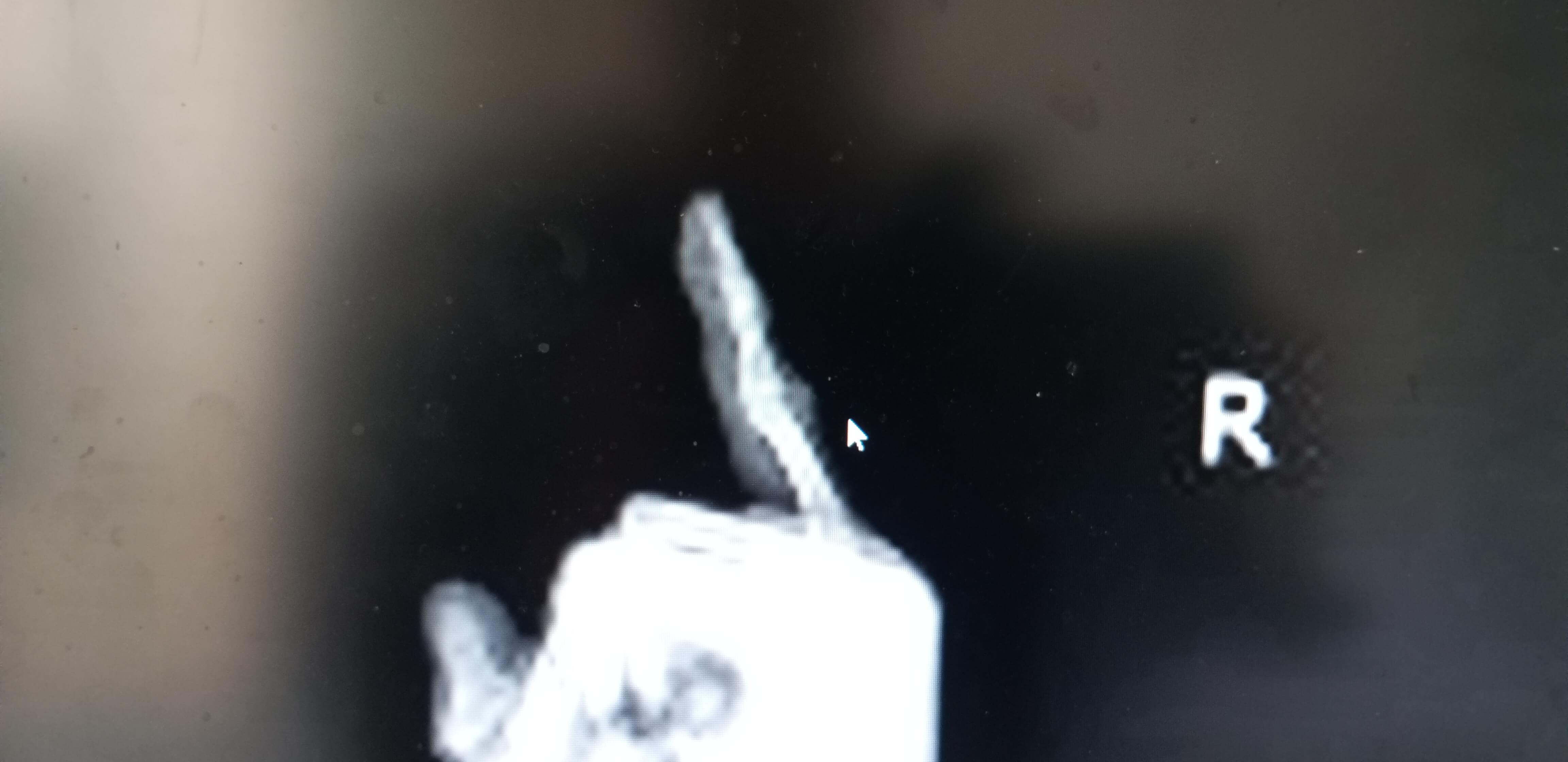 새끼손가락바로잡기사진