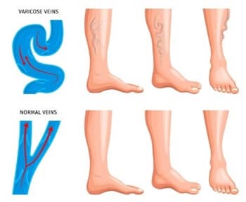 하지정맥류 자가 진단 초기 증상 좋은 운동 예방