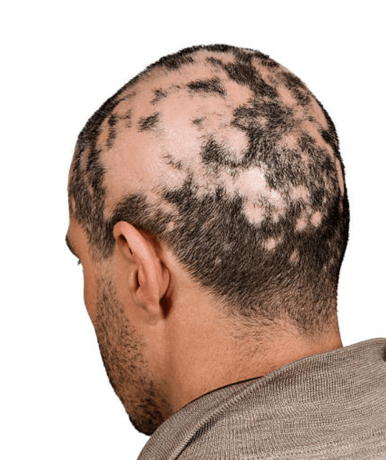 탈모 원인과 예방방법
