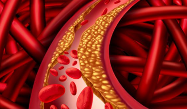 콜레스테롤 높으면 나타나는 증상