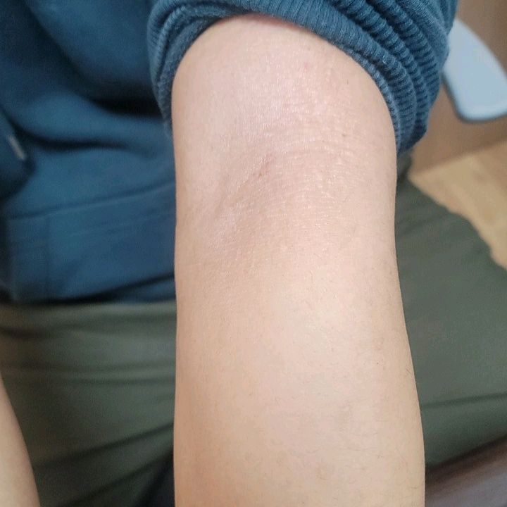 갑자기 생기는 가려움증 두드러기 아토피 치료방법