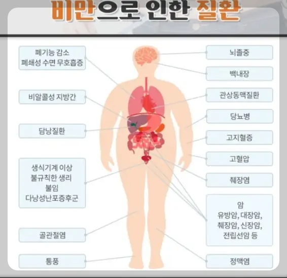 비만으로 인한 질환