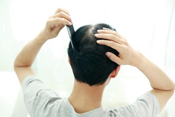 미녹시딜가격