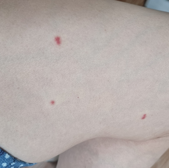 좀벌레 물린자국