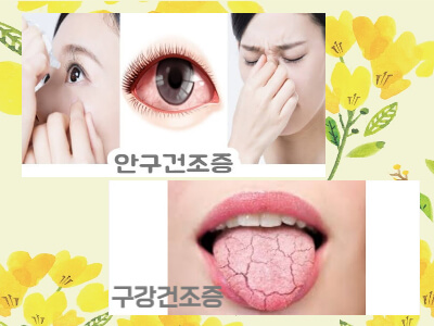 쇼그렌증후군 증상과 치료방법