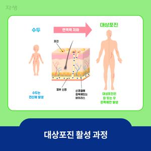 대상포진 통증완화방법,좋은음식,관리법(흉터,신경통),무료접종