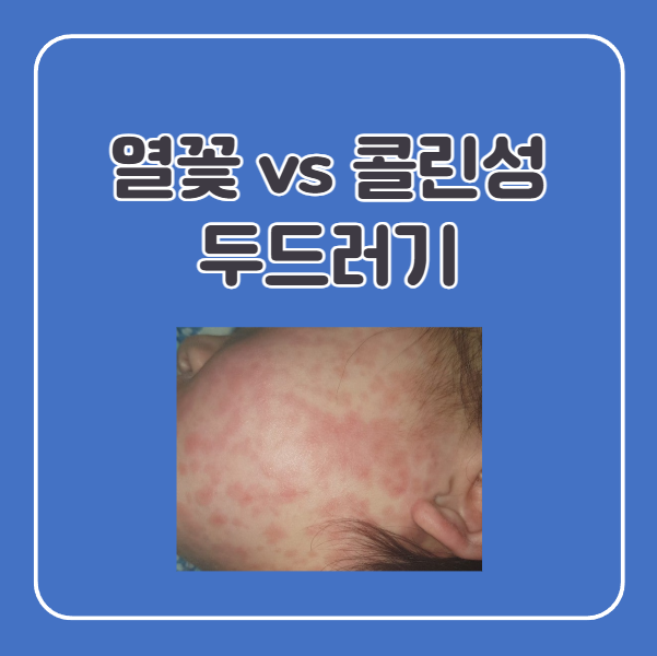 열꽃 두드러기, 콜린성 두드러기 차이점