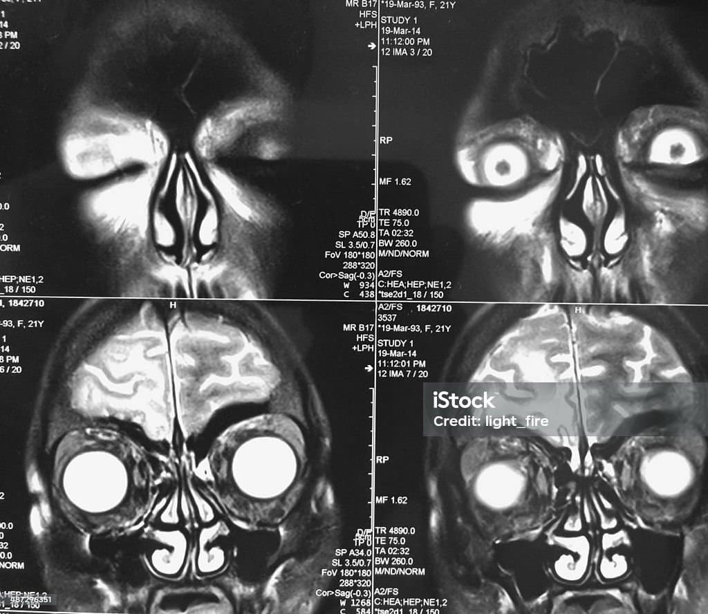 비중격만곡증은 꼭 수술해야 하나