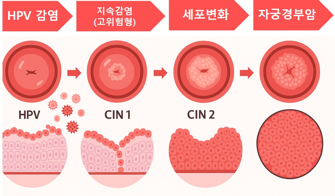 HPV 감염 후 자궁경부 세포 변화 과정