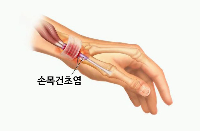 손목터널증후군 증상
