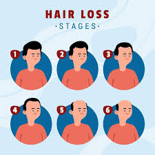 남성형 탈모는 무엇인가.